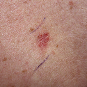Skin Cancer, Basal Cell Carcinoma, Superficial