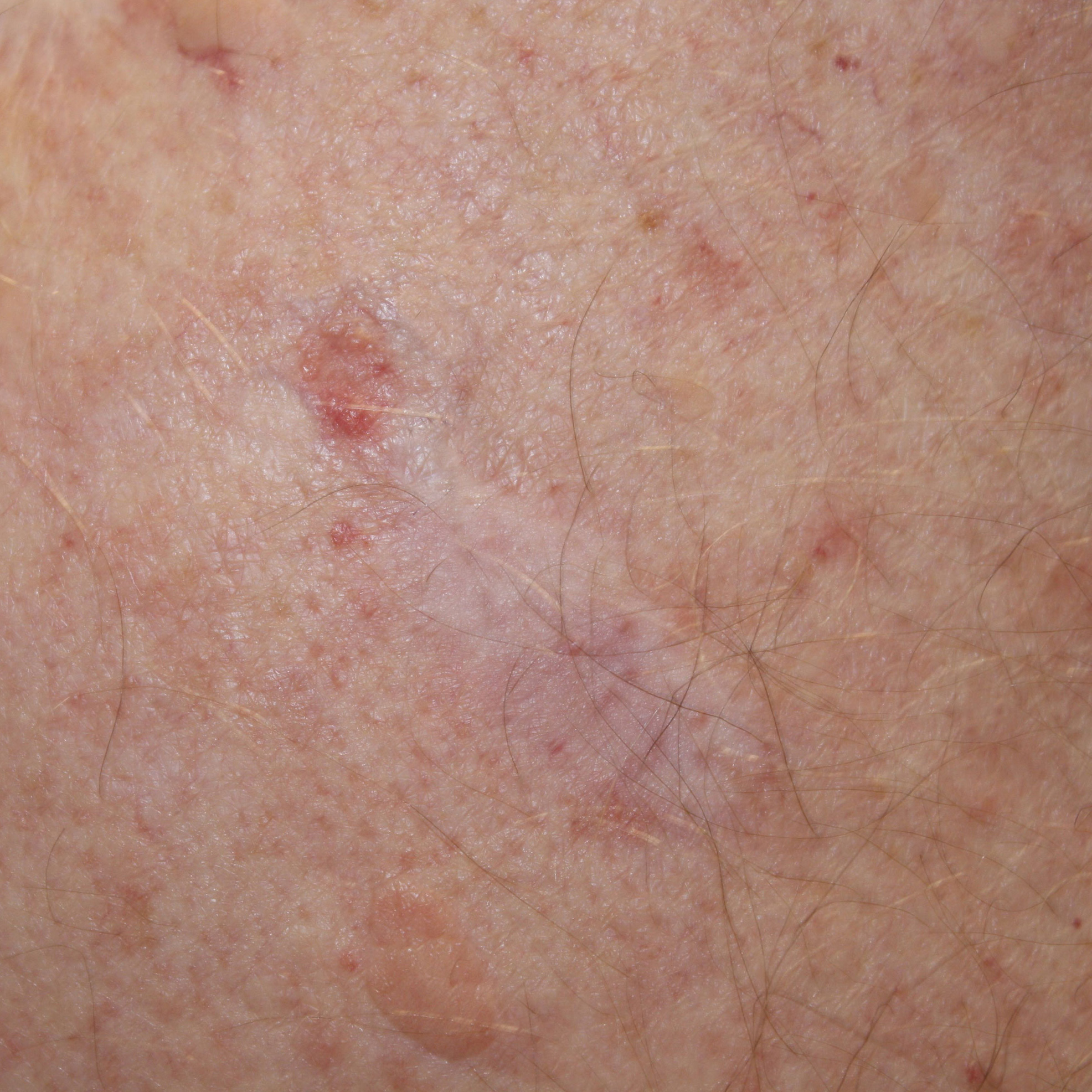 Asymmetrical Melanoma