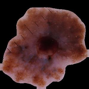 Asymmetrical Melanoma