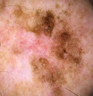 Skin Cancer, Basal Cell Carcinoma, Superficial