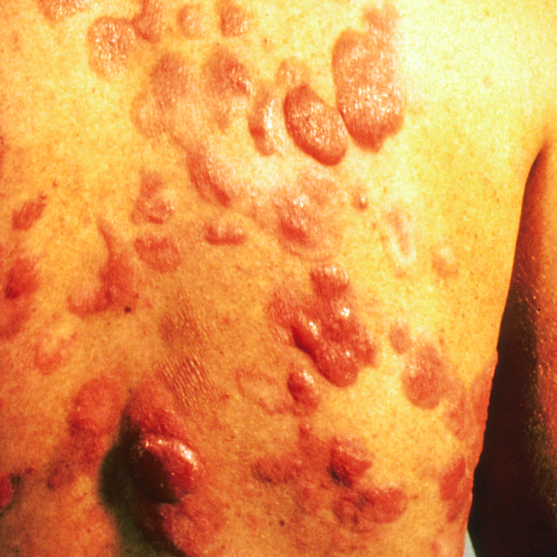Skin Cancer, Basal Cell Carcinoma, Superficial