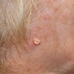Melanoma Skin Cancer