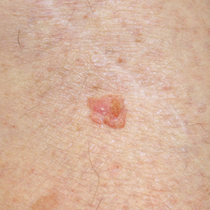 Skin Cancer, Basal Cell Carcinoma, Superficial